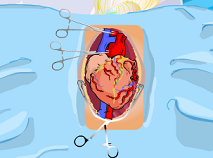 Elsa Heart Surgery 